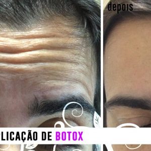 Botox - Antes e depois